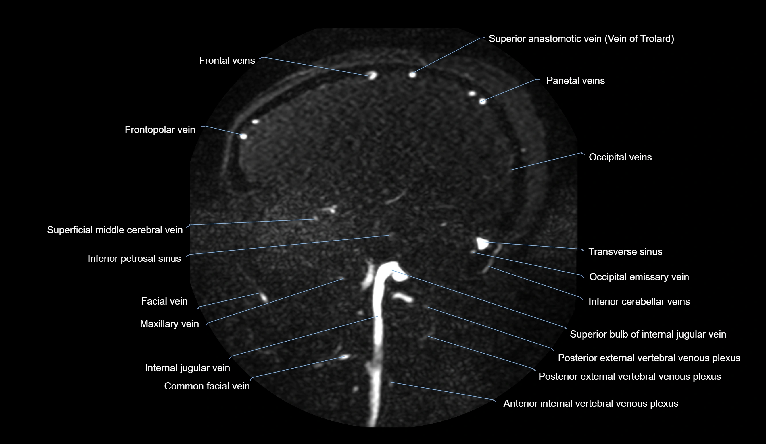MRV brain sagittal anatomy 3T MRI images -img-01015-00057.webp